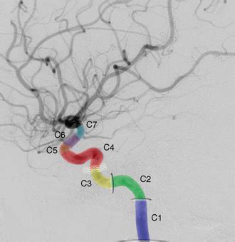 Internal Carotid Artery Segments Radiology