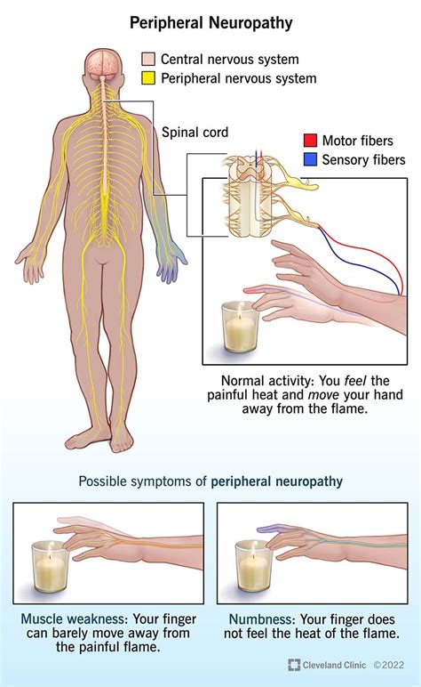 Peripheral Neuropathy: What It Is, Symptoms & Treatment (2023)