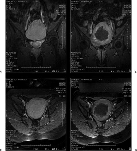 New Treatments for Uterine Fibroids | Radiology Key