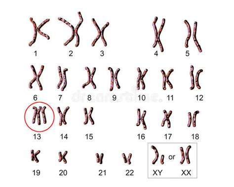 Patau Syndrome - Symptoms, Causes, Diagnosis & Treatment - Santripty