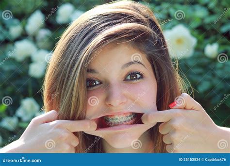 Funny Expression with Braces Stock Photo - Image of silver, teenager ...