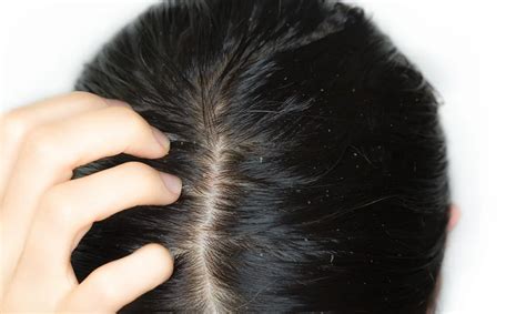 Does Scalp Eczema Cause Hair Loss?