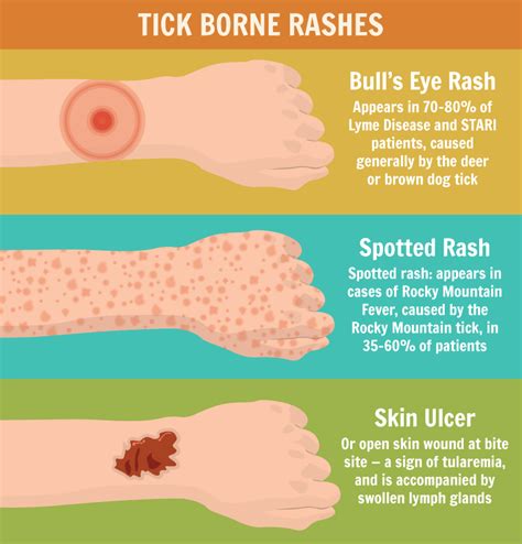 How to Prevent and Manage Tick Bites [Infographic] | The NOLS Blog