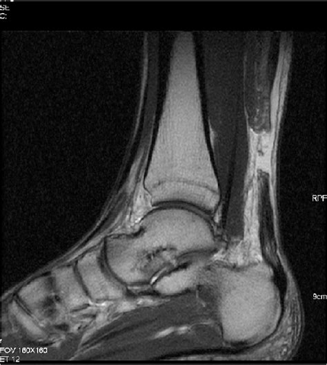 MRI of Achilles's tendon rupture. MRI appearance of Achilles tendon... | Download Scientific Diagram