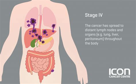 Colorectal Cancer Stages