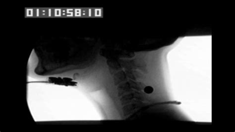 volitional laryngeal vestibule closure (vLVC) - YouTube