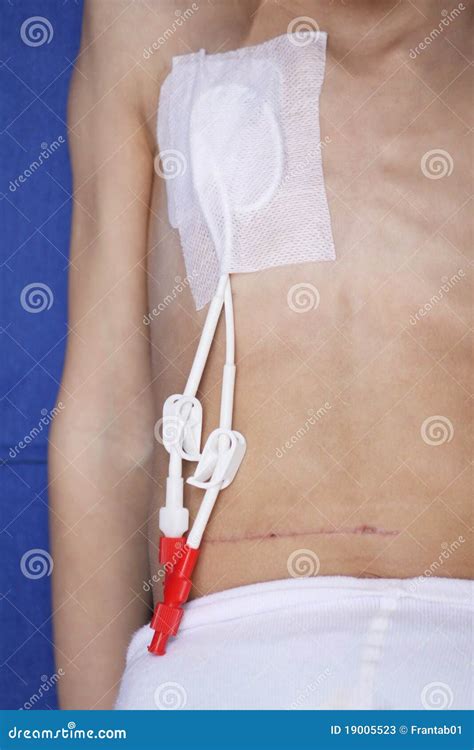 Hickman Catheter Stock Photos - Image: 19005523