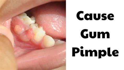 Gum Pimple: Causes & Treatment At Spring Orchid Dental