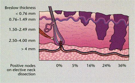 Melanoma Clark stage