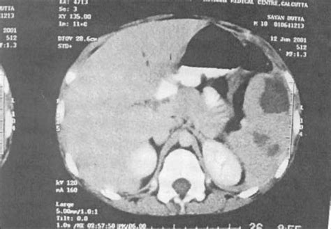 CT scan showing multiple splenic abscesses. | Download Scientific Diagram