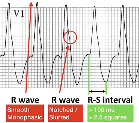 How to read an ecg with animations in 10 mins – Artofit