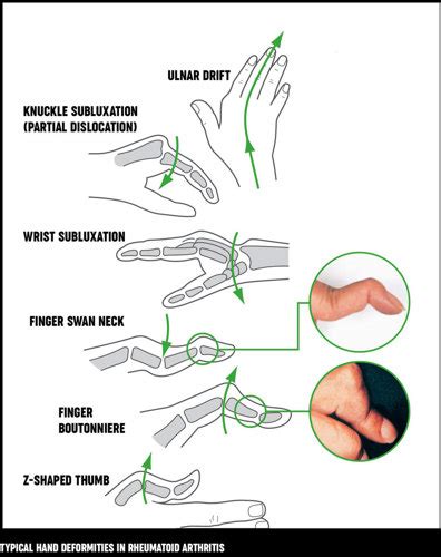 Joint care | Rheumatoid Arthritis (RA) support program - homepage | Arthritis Australia