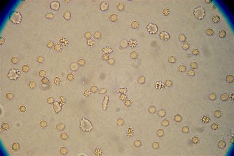 RBC in Urine Sediment