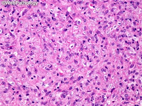 Webpathology.com: A Collection of Surgical Pathology Images