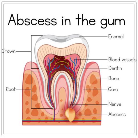 Gum Boil: Causes, Symptoms, and Treatment - DentistAhmed