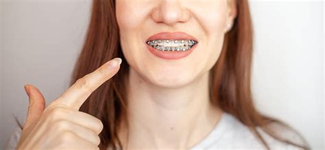 Facts About Traditional Metal Braces and What You Should Know