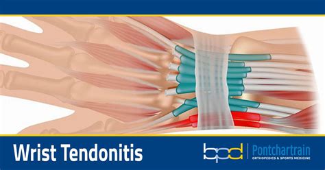 Wrist Tendonitis - Brandon P. Donnelly, MD