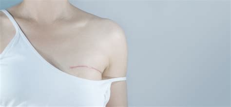 Mastectomy Surgical Types For Breast Cancer - Regional Cancer Care ...