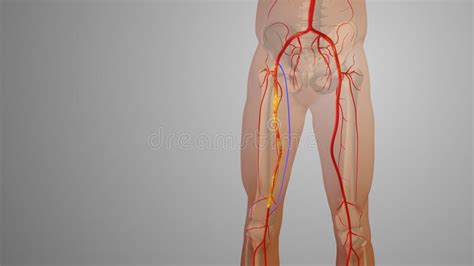 Peripheral Artery Bypass Surgery Medical Animation Stock Illustration - Illustration of ...