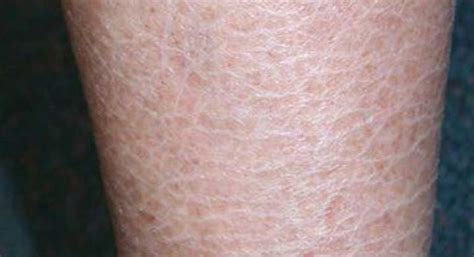 Ichthyosis Vulgaris and Diet: Is There a Connection? | Dry skin remedies, Dry flaky skin, Dry ...