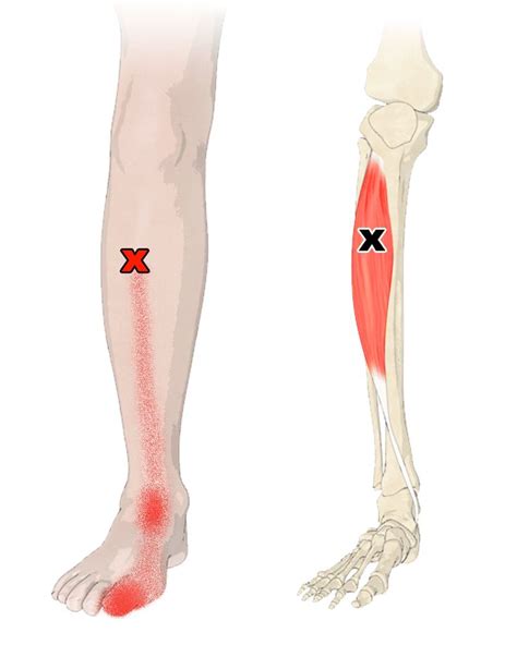 The Tibialis Anterior Muscle | Trigger points, Lower leg muscles ...