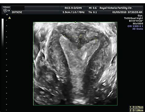 Do Measurements of Uterine Septum Using Three-Dimensional Ultrasound and Magnetic Resonance ...