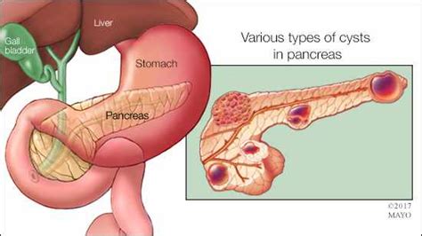 Mayo Clinic Q and A: Why pancreatic cysts usually are not worrisome ...