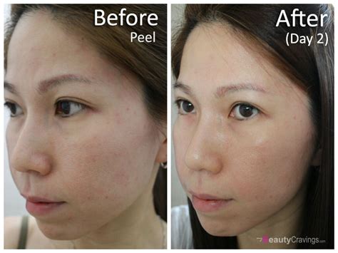 Review: At-Home 40% Glycolic Acid Peel from MUAC (Part 2) » myBeautyCravings