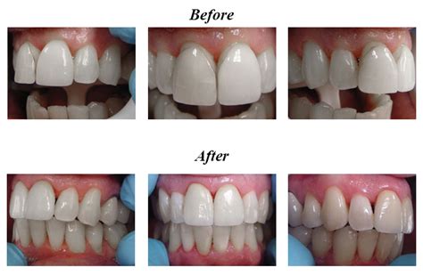 Smile Gallery - Before and After Dental Photos - Smile Makeovers Clifton, NJ