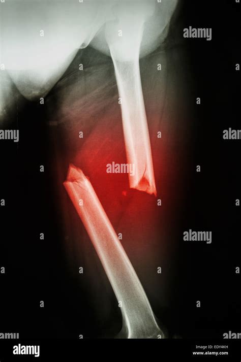 Film X-ray Left femur(left thigh) show complete fracture shaft of femur and displace Stock Photo ...