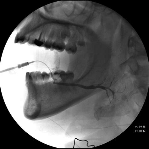 Normal Submandibular Sialogram Sequence | Iowa Head and Neck Protocols