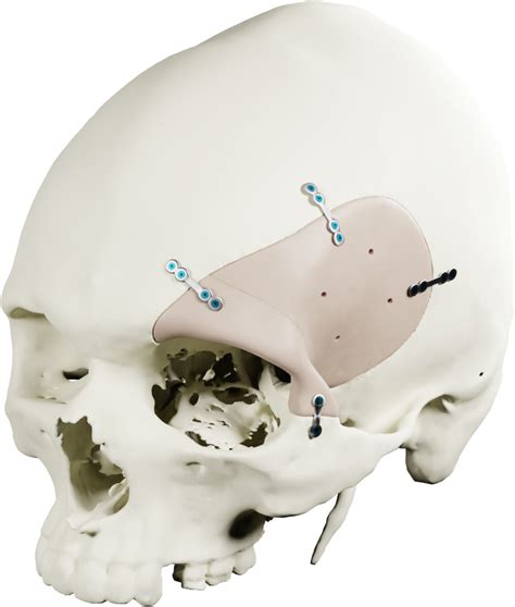 AccuShape PEEK Implants | MedCAD