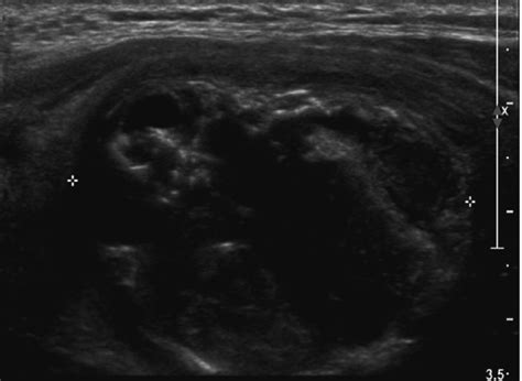 Thyroid ultrasonography showing a 3.1 × 2.6 × 3.9 cm heterogeneous ...