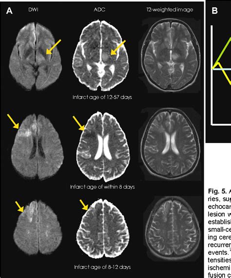 Figure 5 from Multimodal MRI for Ischemic Stroke: From Acute Therapy to Preventive Strategies ...