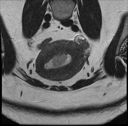 Endometrial Cancer Staging