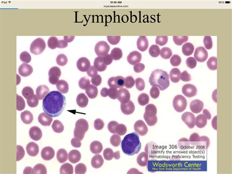 Lymphoblast | Hematology, Medical laboratory science, Medical laboratory