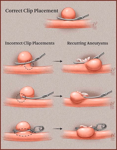 P-020 Patterns of aneurysm recurrence following microsurgical clip obliteration | Journal of ...