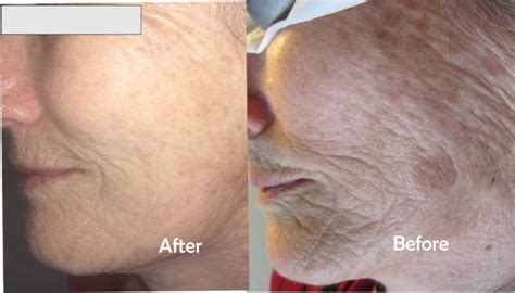 wrinkles, age spots removal Toronto, brown spots,dark spots on face, Nell laser clinic | Nell ...