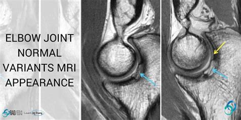 Elbow Joints Normal Variants on MRI - Radedasia