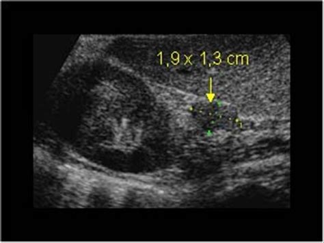 Abdomen and retroperitoneum | 1.10 Adrenal glands : Case 1.10.2 Adrenal adenomas | Ultrasound Cases