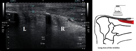 Ultrasound Images of Achilles Tendinopathy - Ankle, Foot and Orthotic Centre