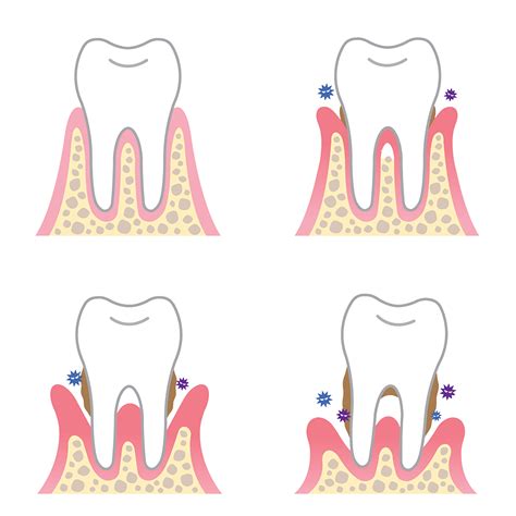 How periodontal (gum) disease causes tooth loss - Complete Smile Dental