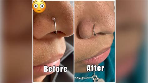 Get rid of that nose piercing bump FOR GOOD! Find out what really works ...