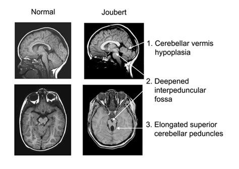 Joubert Syndrome - UW Hindbrain Malformation Research Program