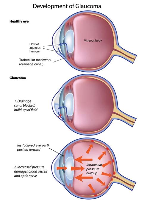 Glaucoma - High Internal Eye Pressure That Causes Vision Loss