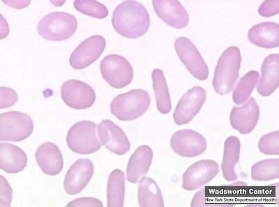 Hello USA: elliptocytes