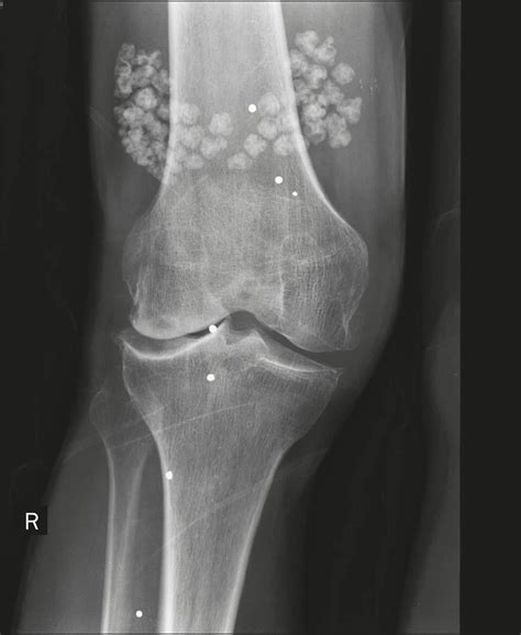 SciELO - Brasil - Soft tissue calcifications: a pictorial essay Soft tissue calcifications: a ...