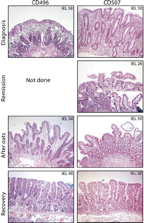 Histology of Intestinal Mucosa of Two of the Oat-Intolerant Patients... | Download Scientific ...