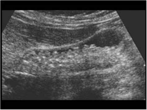 Abdomen and retroperitoneum | 1.2 Gallbladder and bile ducts : Case 1.2.15 Bile duct: Sludge and ...