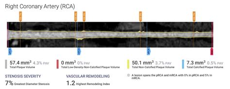 New Heart Disease Screening Detects Early Risk Signs Of Heart Attacks